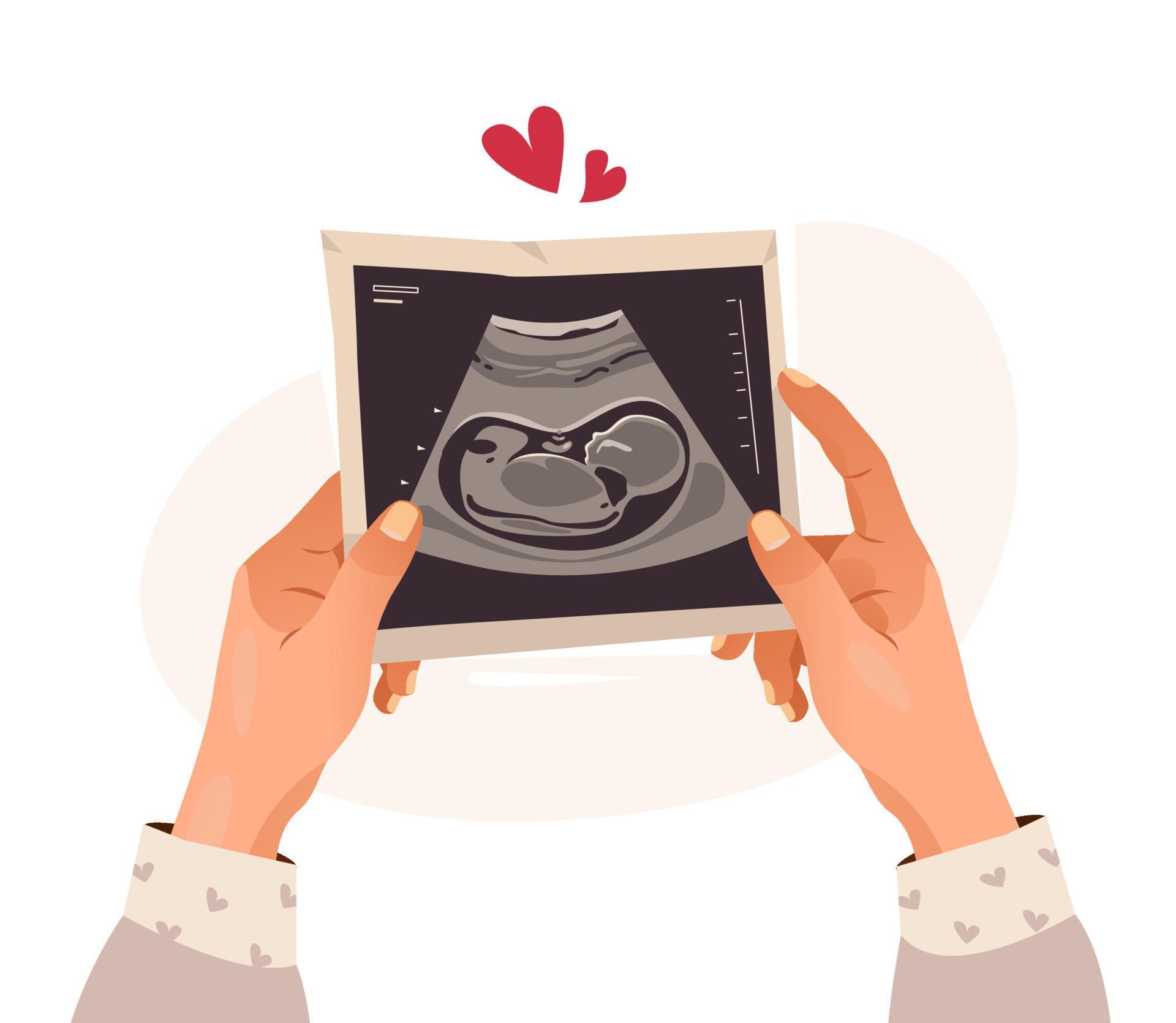 Julie Durafour Sage Femme Les Angles Hands Holding A Photo Of A Baby On Ultrasound Scan In The Womb Ultrasound Of The Child Pregnancy Cartoon Illustration Vector